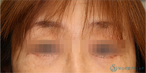 【50代女性・目の下のたるみをスッキリ】下眼瞼切開術/下眼瞼除皺術/ハムラ法（術後1ヶ月） After 