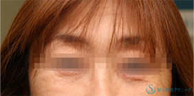 【50代女性・目の下のたるみをスッキリ】下眼瞼切開術/下眼瞼除皺術/ハムラ法（術後1ヶ月） After 