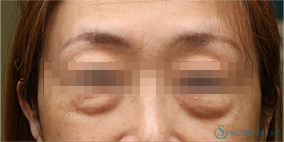 【50代女性・目の下のたるみをスッキリ】下眼瞼切開術/下眼瞼除皺術/ハムラ法（術後1ヶ月） Before 