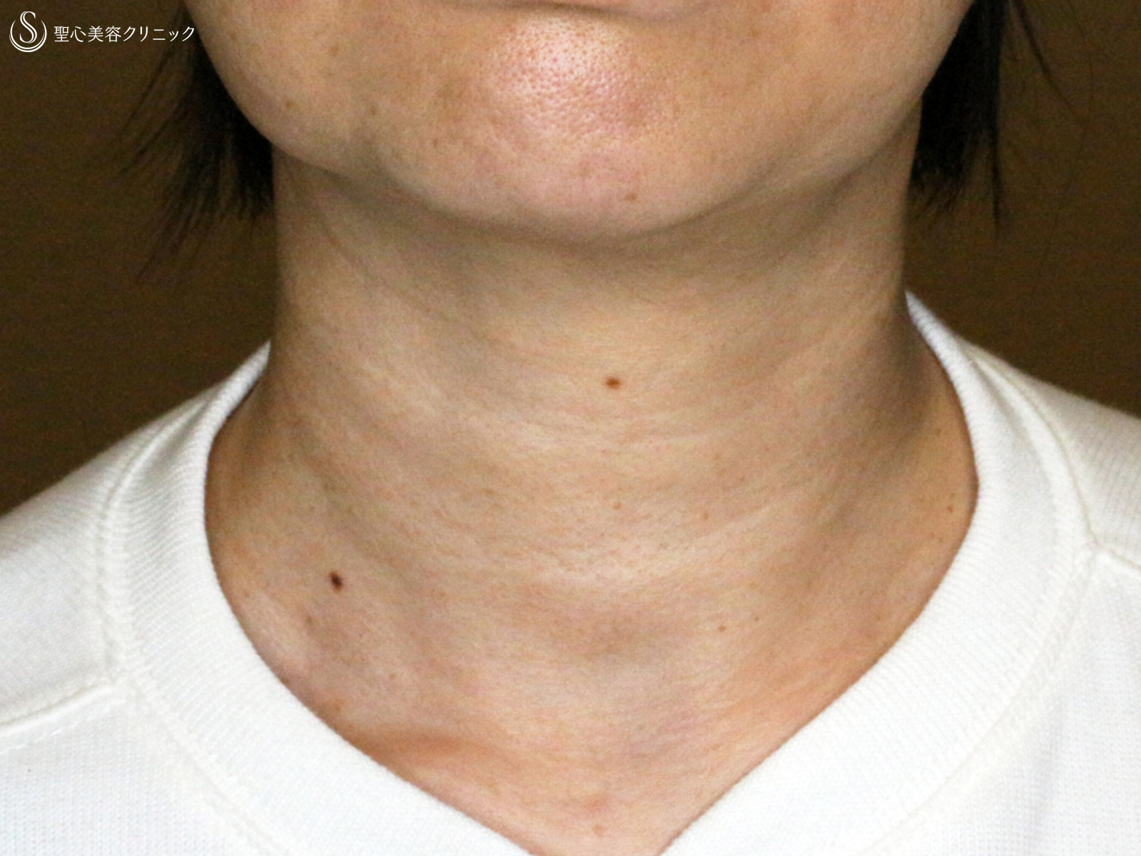 【40代女性・「ミシュランタイプ」首の横ジワ】プレミアムPRP皮膚再生療法（直後〜2年3ヶ月後） After 