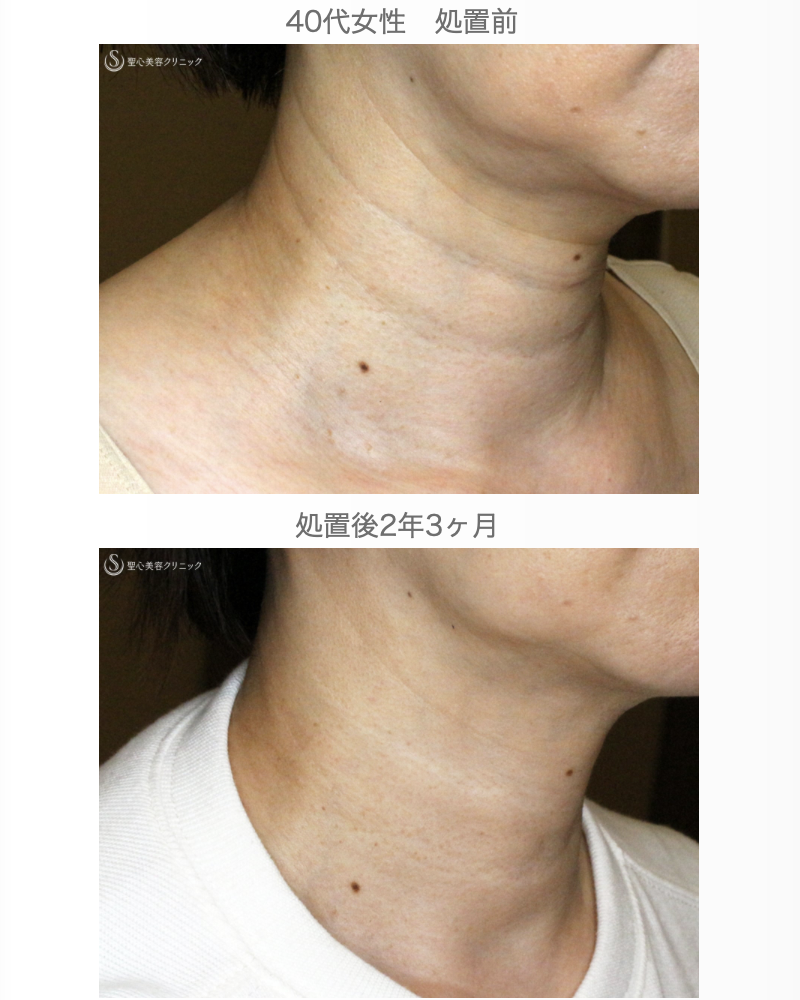 【40代女性・「ミシュランタイプ」首の横ジワ】プレミアムPRP皮膚再生療法（直後〜2年3ヶ月後） After 