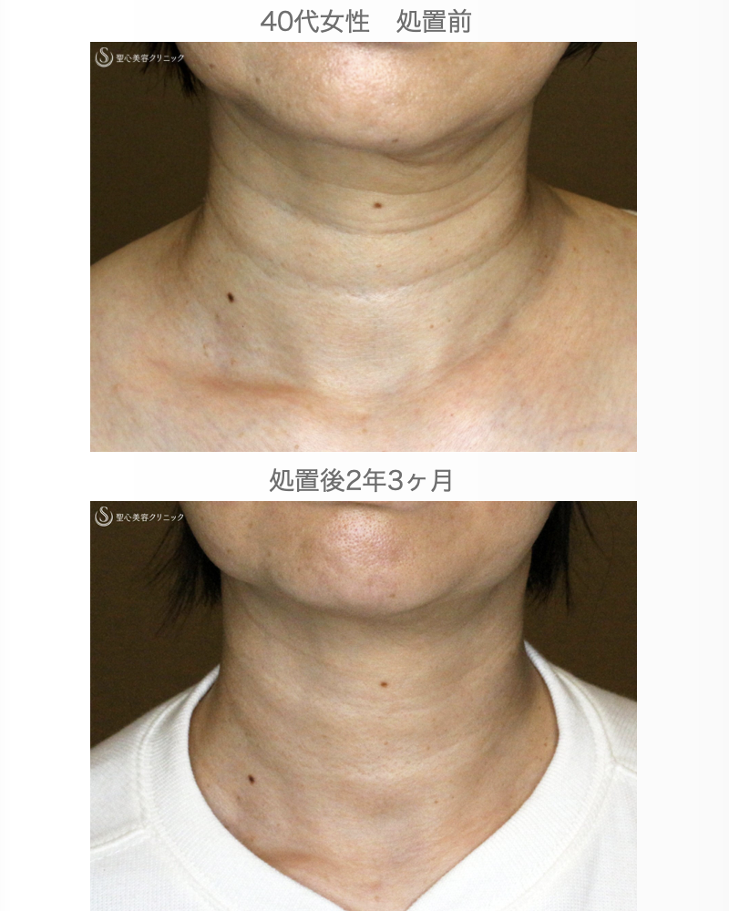 【40代女性・「ミシュランタイプ」首の横ジワ】プレミアムPRP皮膚再生療法（直後〜2年3ヶ月後） After 