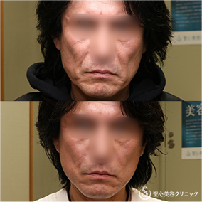 【50代男性・切開リフトでスッキリ】プレミアムミニリフト＋リガメント処理（1ヶ月後） After 
