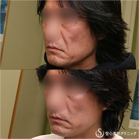 【50代男性・切開リフトでスッキリ】プレミアムミニリフト＋リガメント処理（1ヶ月後） After 