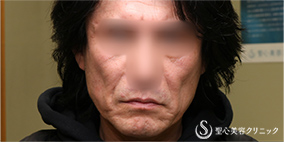 【50代男性・切開リフトでスッキリ】プレミアムミニリフト＋リガメント処理（1ヶ月後） Before 
