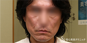 【50代男性・切開リフトでスッキリ】プレミアムミニリフト＋リガメント処理（1ヶ月後） After 
