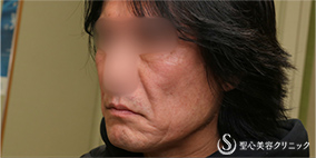 【50代男性・切開リフトでスッキリ】プレミアムミニリフト＋リガメント処理（1ヶ月後） Before 