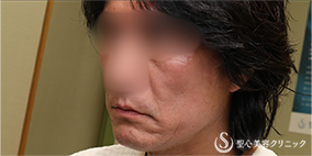【50代男性・切開リフトでスッキリ】プレミアムミニリフト＋リガメント処理（1ヶ月後） After 