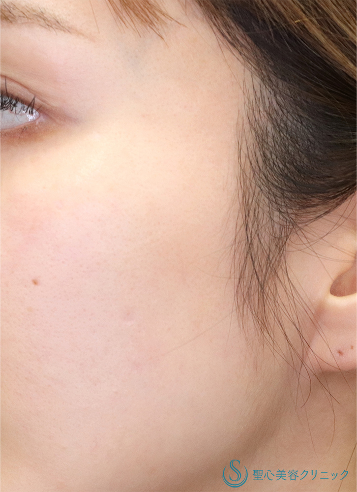 【20代女性・肌の陥没を改善】プレミアムPRP皮膚再生療法（術後1年） After 