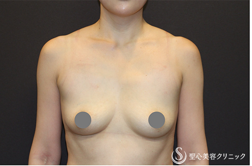 【30代女性・デコルテラインを綺麗にしたい】バックプロテーゼ挿入法（Motiva Ergonomix2 mini 220cc）（術後3ヶ月） Before 