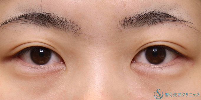 【20代女性・全切開法で綺麗な二重になりたい！！】二重術（全切開）＋脱脂（術後1ヶ月） Before 