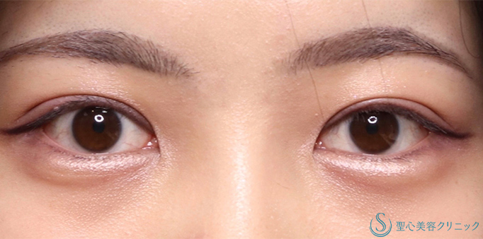 【20代女性・全切開法で綺麗な二重になりたい！！】二重術（全切開）＋脱脂（術後1ヶ月） After 