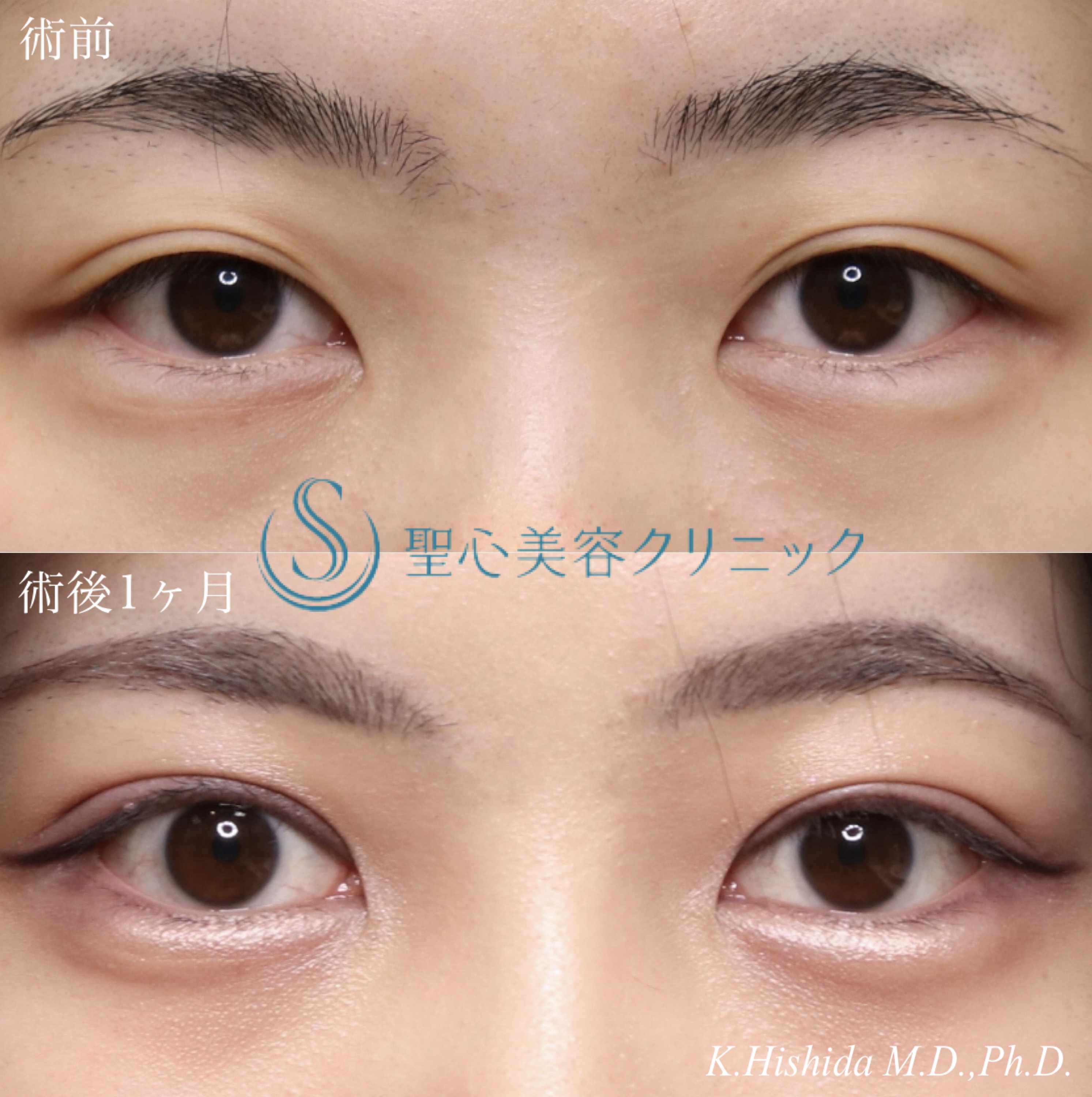 【20代女性・全切開法で綺麗な二重になりたい！！】二重術（全切開）＋脱脂（術後1ヶ月） After 