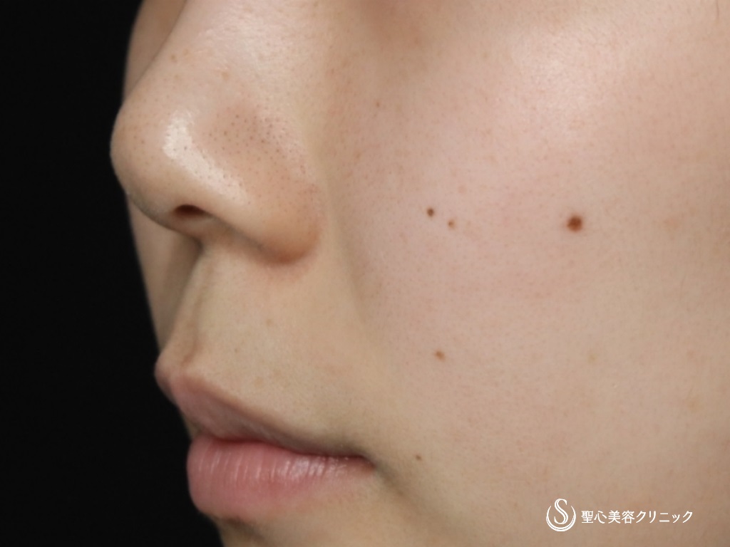 【20代女性・鼻先がスッキリしました】鼻尖形成（耳介軟骨移植）＋鼻尖縮小＋リップリフト（術後1ヶ月） Before 