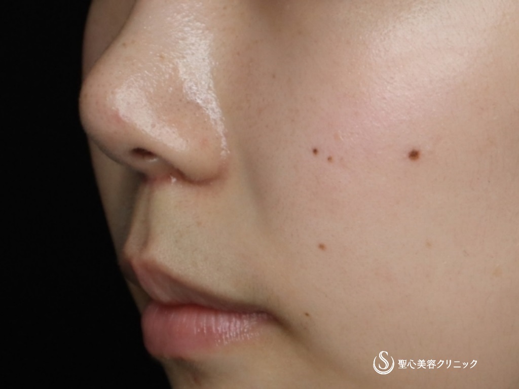 【20代女性・鼻先がスッキリしました】鼻尖形成（耳介軟骨移植）＋鼻尖縮小＋リップリフト（術後1ヶ月） After 