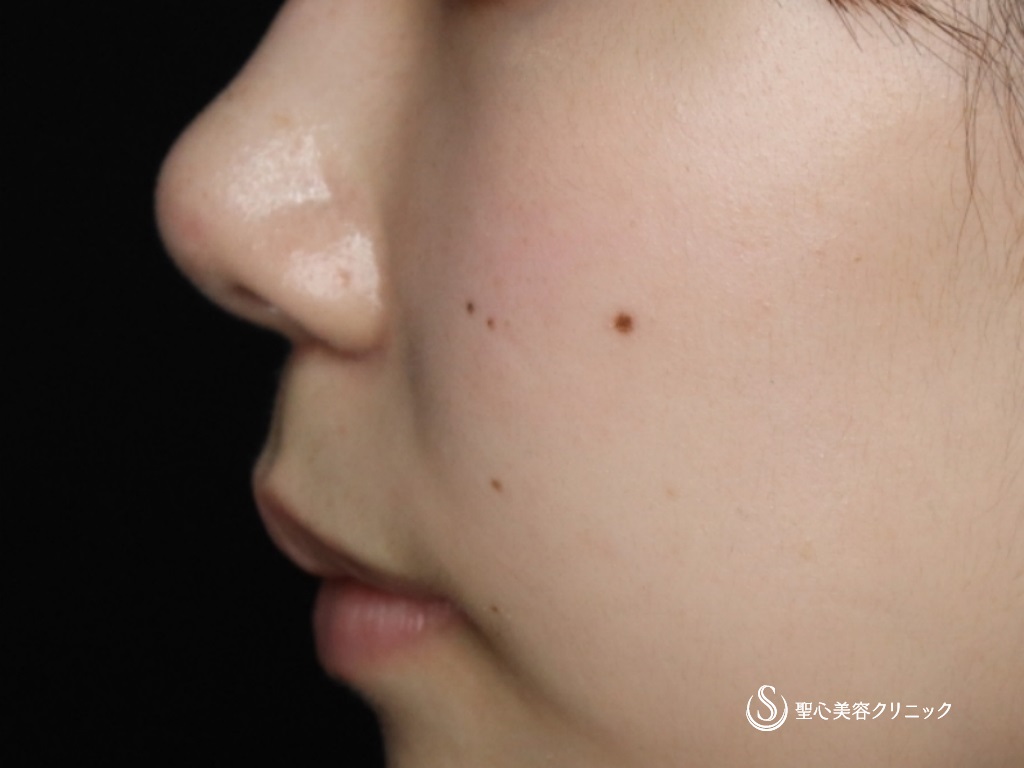 【20代女性・鼻先がスッキリしました】鼻尖形成（耳介軟骨移植）＋鼻尖縮小＋リップリフト（術後1ヶ月） After 