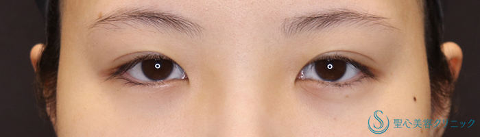 【20代女性・蒙古襞を解除し、華やかなお目元に】目頭切開+目上切開（術後3ヶ月） Before 