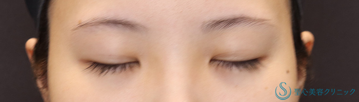 【20代女性・蒙古襞を解除し、華やかなお目元に】目頭切開+目上切開（術後3ヶ月） Before 