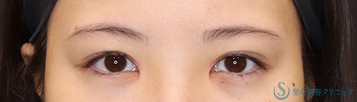 【20代女性・蒙古襞を解除し、華やかなお目元に】目頭切開+目上切開（術後3ヶ月） After 