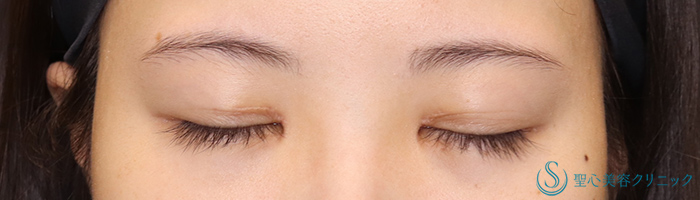 【20代女性・蒙古襞を解除し、華やかなお目元に】目頭切開+目上切開（術後3ヶ月） After 