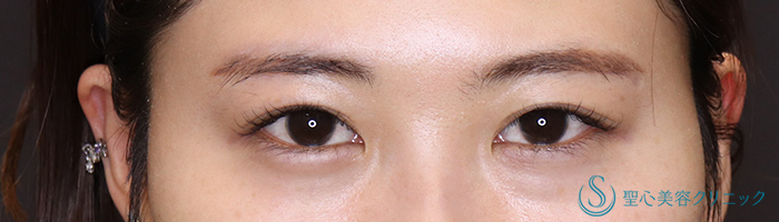 【20代女性・自然な控えめの平行二重に】目上切開（術後3ヶ月） After 