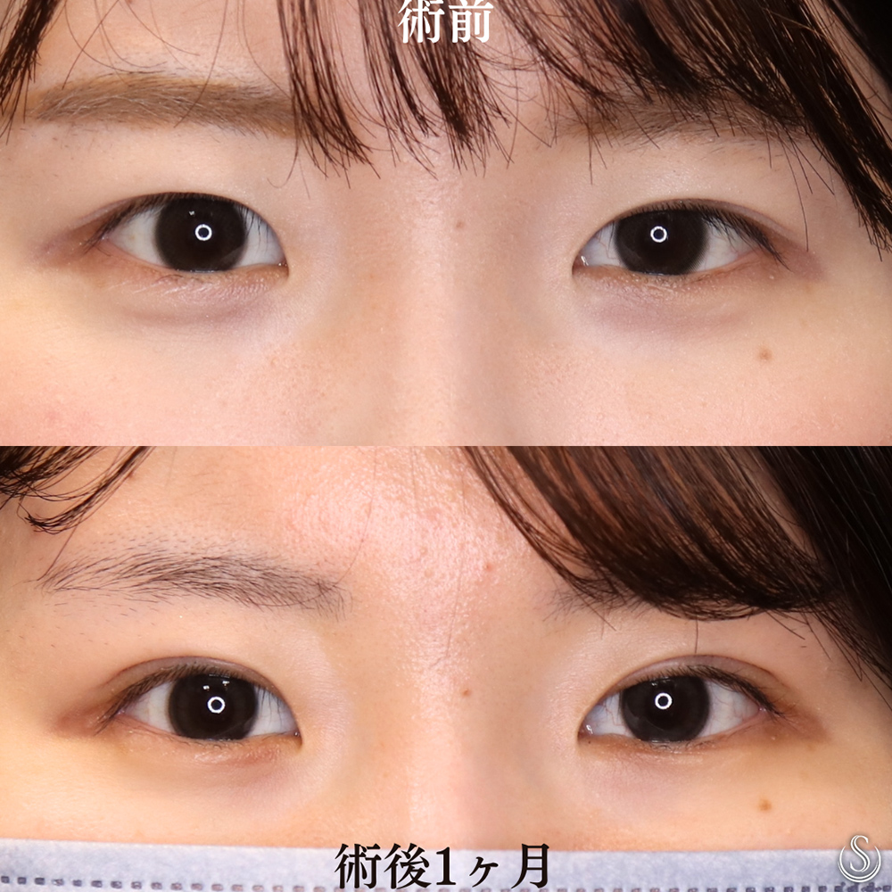 【20代女性・全切開法で綺麗な目元へ】二重術（全切開）（術後1ヶ月） Before 