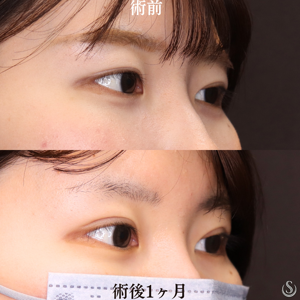 【20代女性・全切開法で綺麗な目元へ】二重術（全切開）（術後1ヶ月） After 