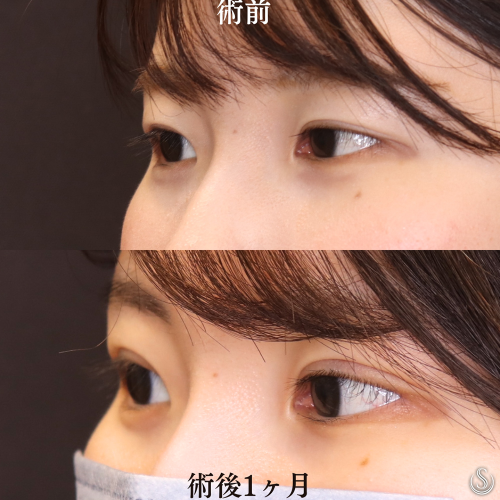 【20代女性・全切開法で綺麗な目元へ】二重術（全切開）（術後1ヶ月） After 
