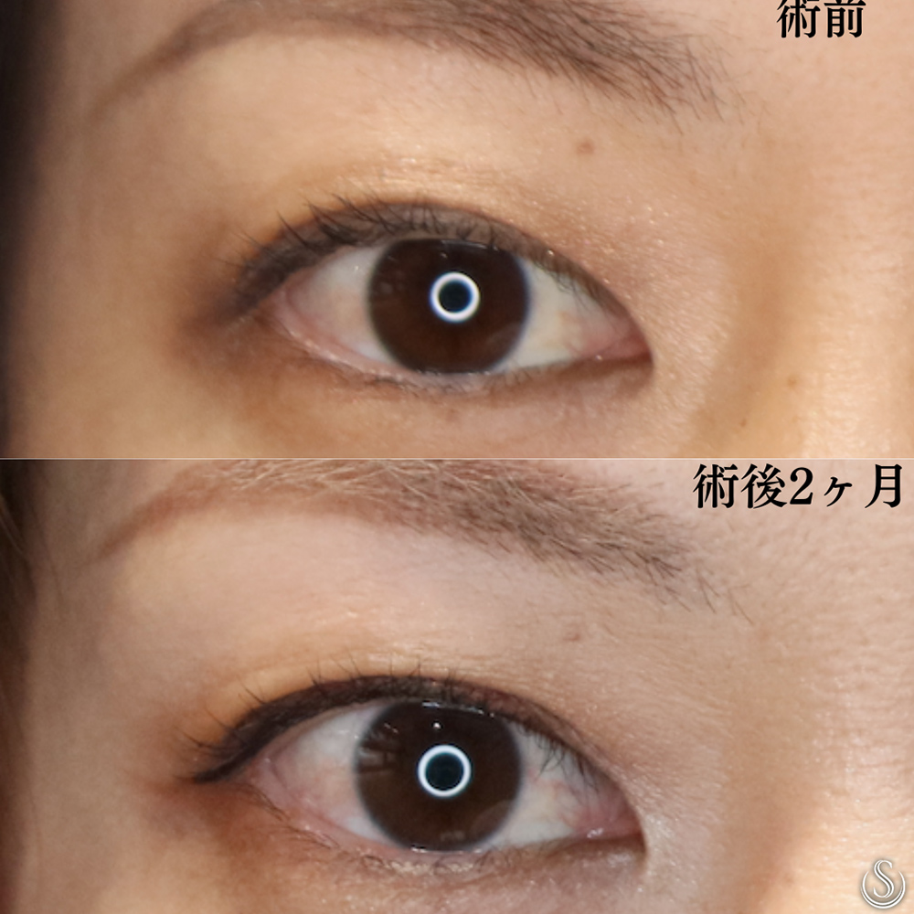 【40代女性・寄り目にしないで二重を内側へ】目上切開（術後2ヶ月） Before 