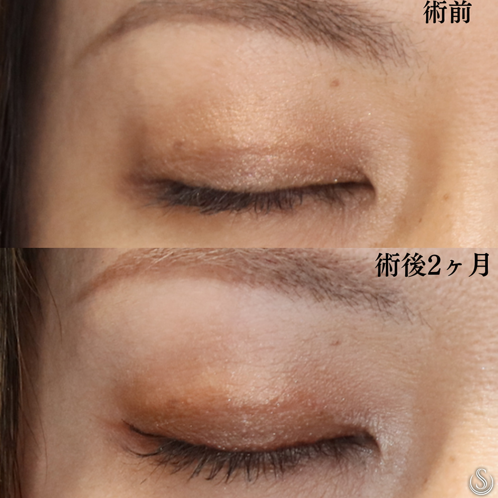 【40代女性・寄り目にしないで二重を内側へ】目上切開（術後2ヶ月） After 