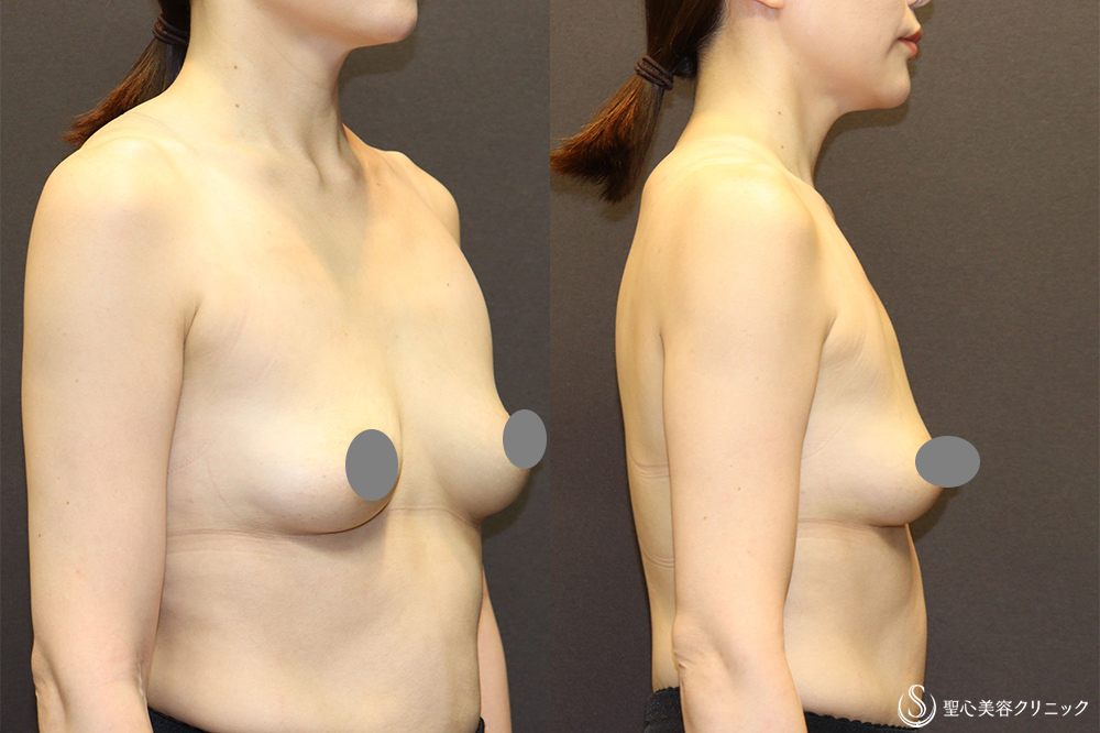 【30代女性・デコルテラインを綺麗にしたい】バックプロテーゼ挿入法（Motiva Ergonomix2 mini 220cc）（術後3ヶ月） Before 