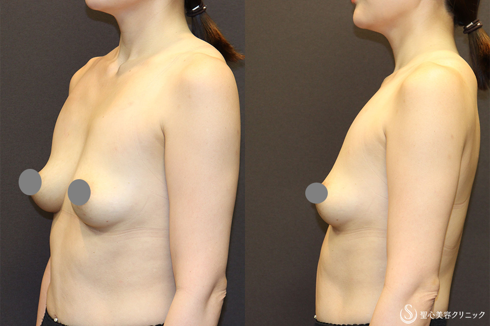 【30代女性・デコルテラインを綺麗にしたい】バックプロテーゼ挿入法（Motiva Ergonomix2 mini 220cc）（術後3ヶ月） Before 