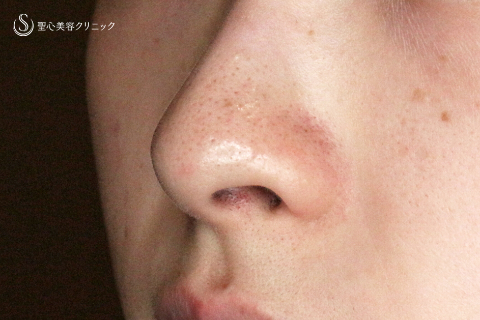 【20代女性・外側切開なしで忘れ鼻】小鼻縮小術+α法「Ver.7」単独（術直後〜1年9ヶ月後） Before 
