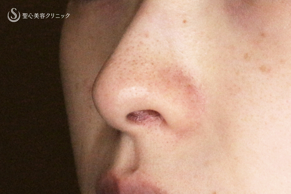 【20代女性・外側切開なしで忘れ鼻】小鼻縮小術+α法「Ver.7」単独（術直後〜1年9ヶ月後） After 