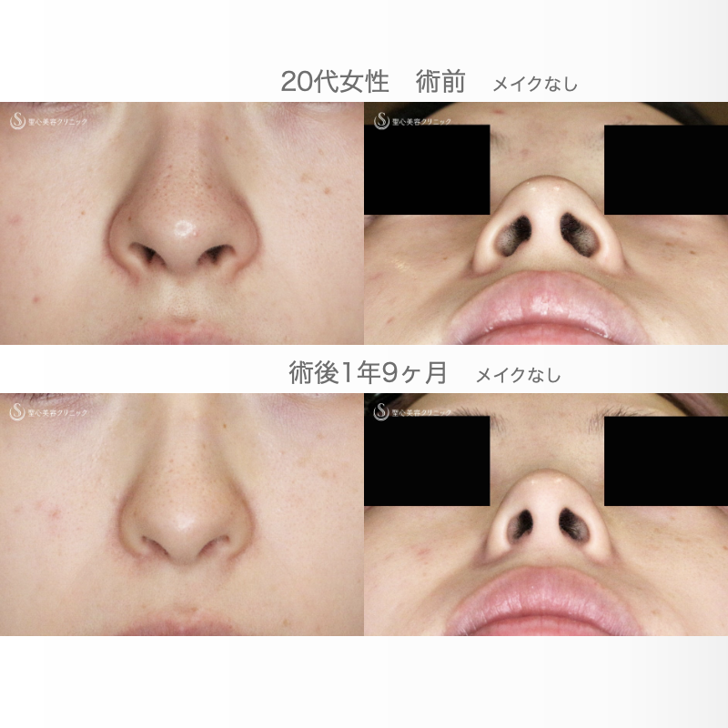【20代女性・外側切開なしで忘れ鼻】小鼻縮小術+α法「Ver.7」単独（術直後〜1年9ヶ月後） After 