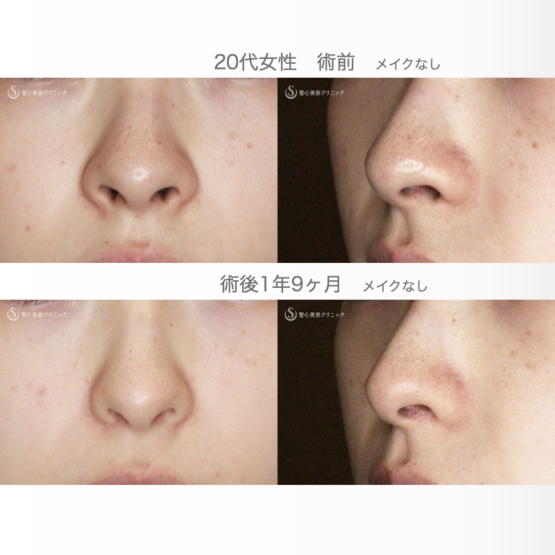 【20代女性・外側切開なしで忘れ鼻】小鼻縮小術+α法「Ver.7」単独（術直後〜1年9ヶ月後） After 