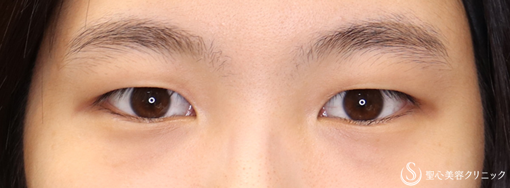 【20代女性・華やかな末広二重に】二重術（埋没法）：マイクロメソッド＋α（二重埋没法）（術後1ヶ月） Before 