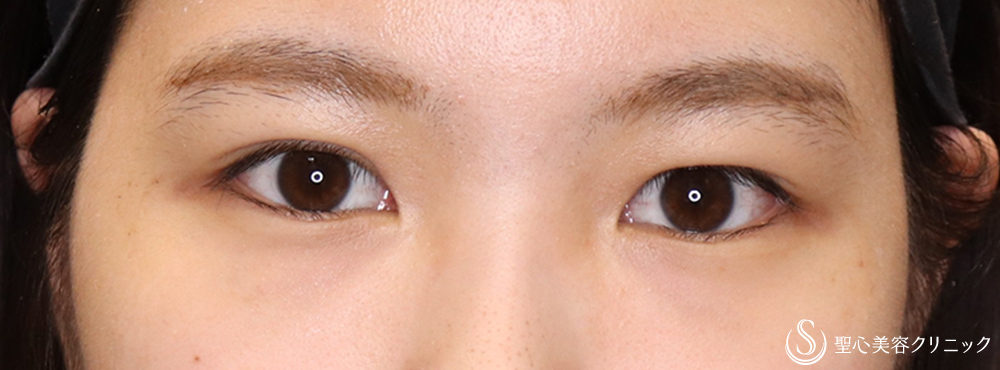 【20代女性・華やかな末広二重に】二重術（埋没法）：マイクロメソッド＋α（二重埋没法）（術後1ヶ月） After 