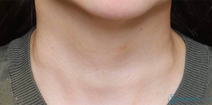 【50代女性・首の横ジワを治したい】プレミアムPRP皮膚再生療法（4年後） After 