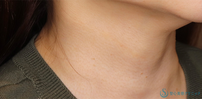 【50代女性・首の横ジワを治したい】プレミアムPRP皮膚再生療法（4年後） After 