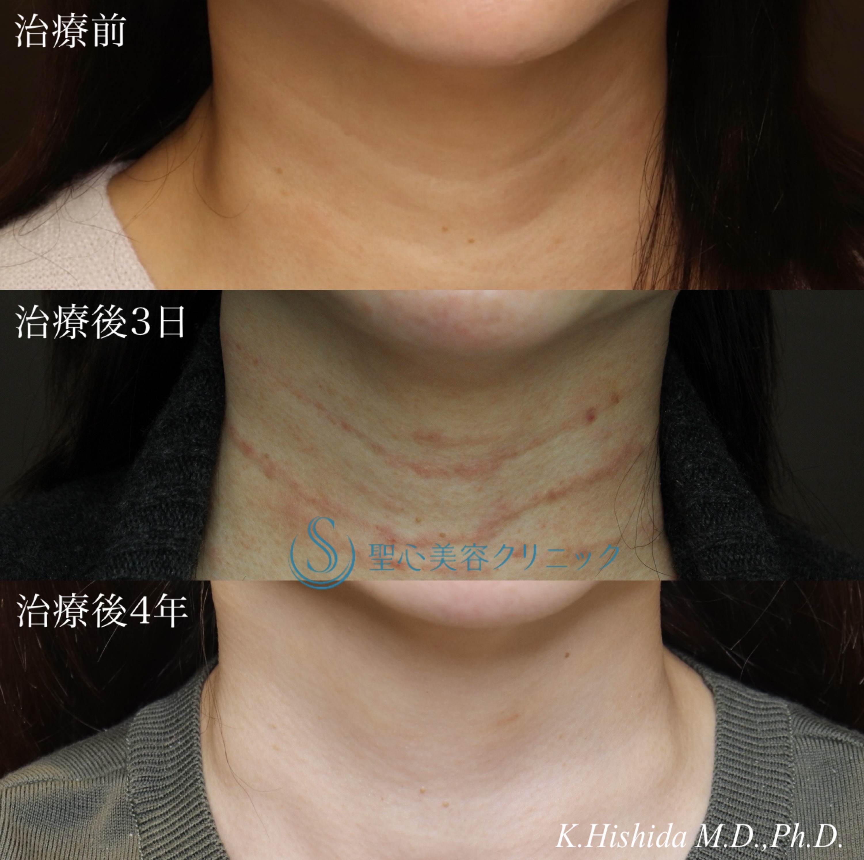 【50代女性・首の横ジワを治したい】プレミアムPRP皮膚再生療法（4年後） After 