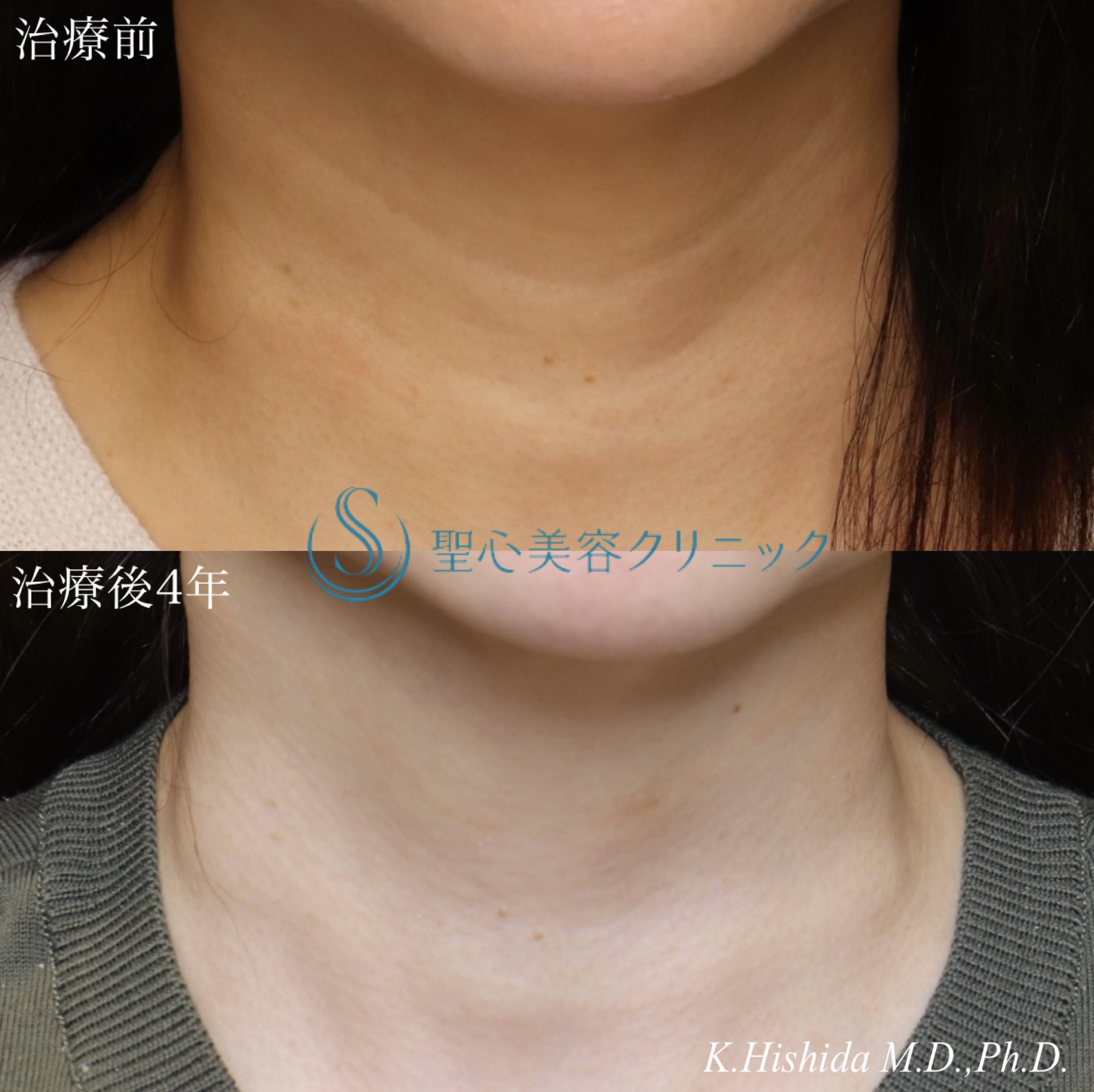 【50代女性・首の横ジワを治したい】プレミアムPRP皮膚再生療法（4年後） After 