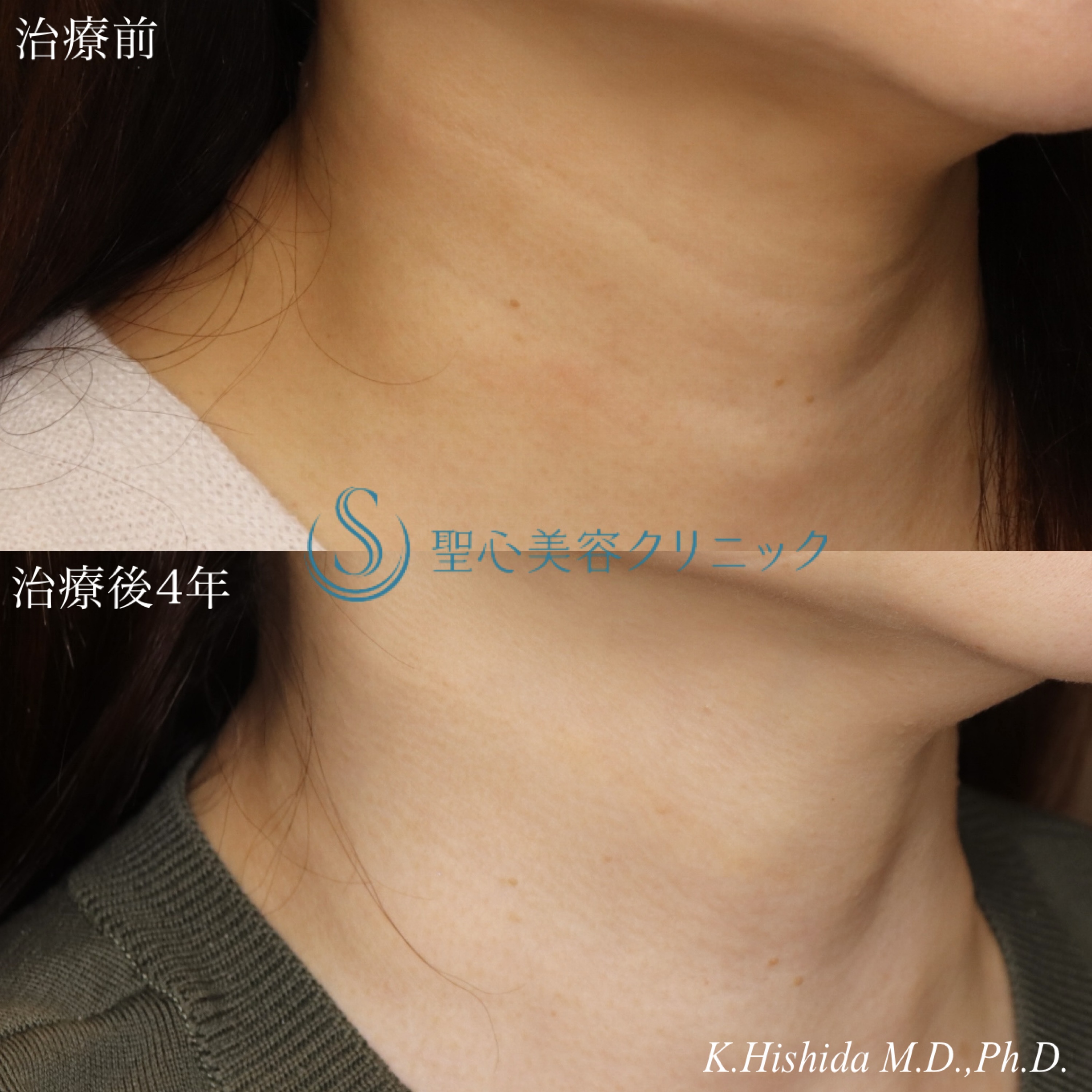 【50代女性・首の横ジワを治したい】プレミアムPRP皮膚再生療法（4年後） After 