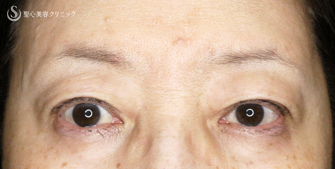 【60代女性・ハードコンタクトによる眼瞼下垂】切らない眼瞼下垂+α法（術直後〜1年後） After 