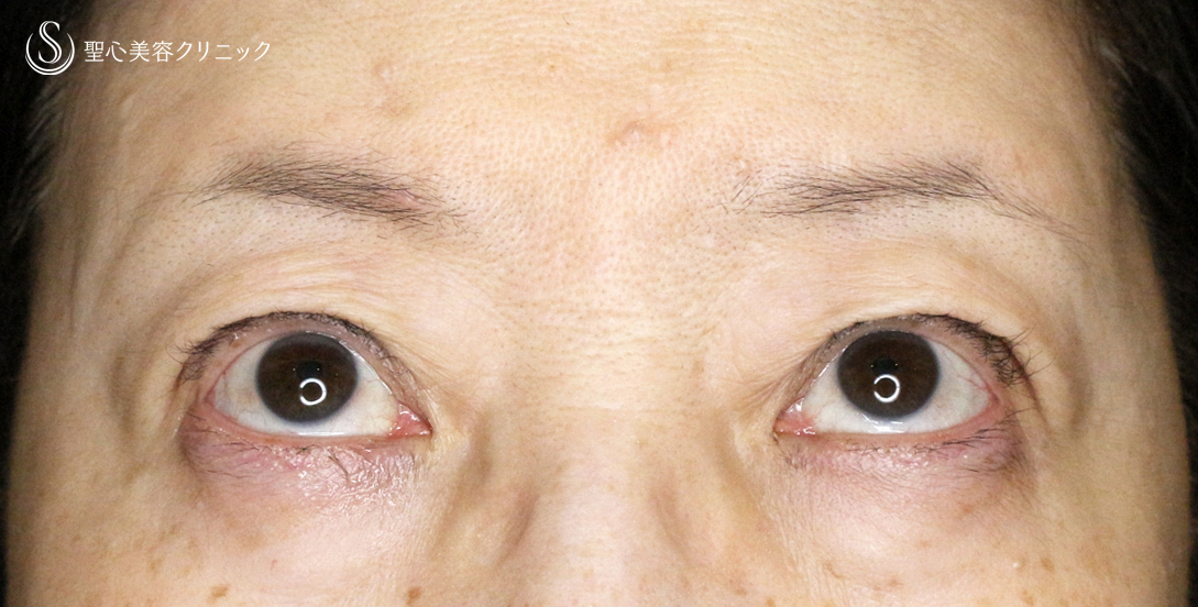 【60代女性・ハードコンタクトによる眼瞼下垂】切らない眼瞼下垂+α法（術直後〜1年後） After 