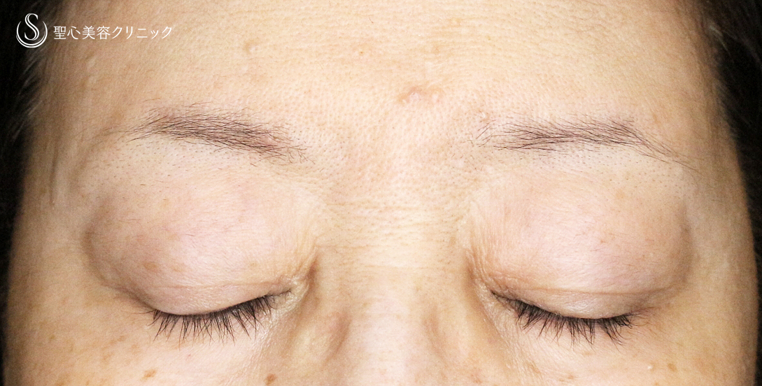 【60代女性・ハードコンタクトによる眼瞼下垂】切らない眼瞼下垂+α法（術直後〜1年後） After 