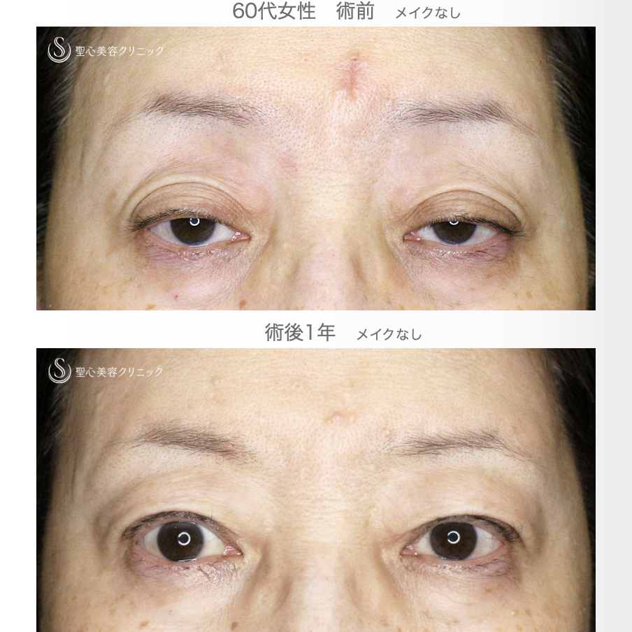 【60代女性・ハードコンタクトによる眼瞼下垂】切らない眼瞼下垂+α法（術直後〜1年後） After 