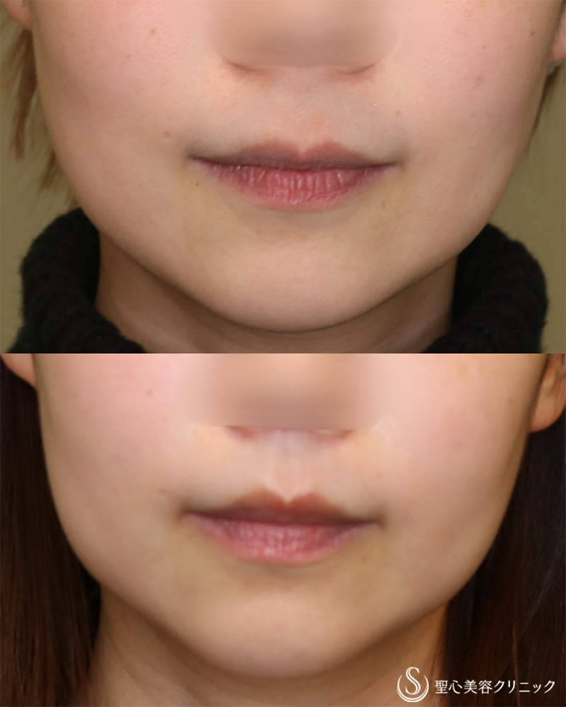 【30代女性・美しい口元になりました】鼻下短縮術（術後1年） After 