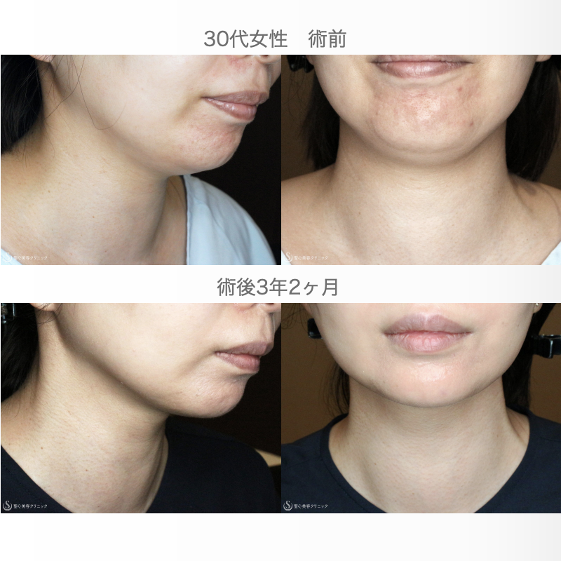【30代女性・シリンジ吸引で二重あご解消】脂肪吸引注射「あご下」（術直後〜3年後） After 