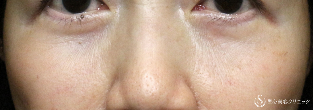 【60代女性・目の下のクマ治療の長期経過】表ハムラ+α法「Ver.2」単独（6年後） After 